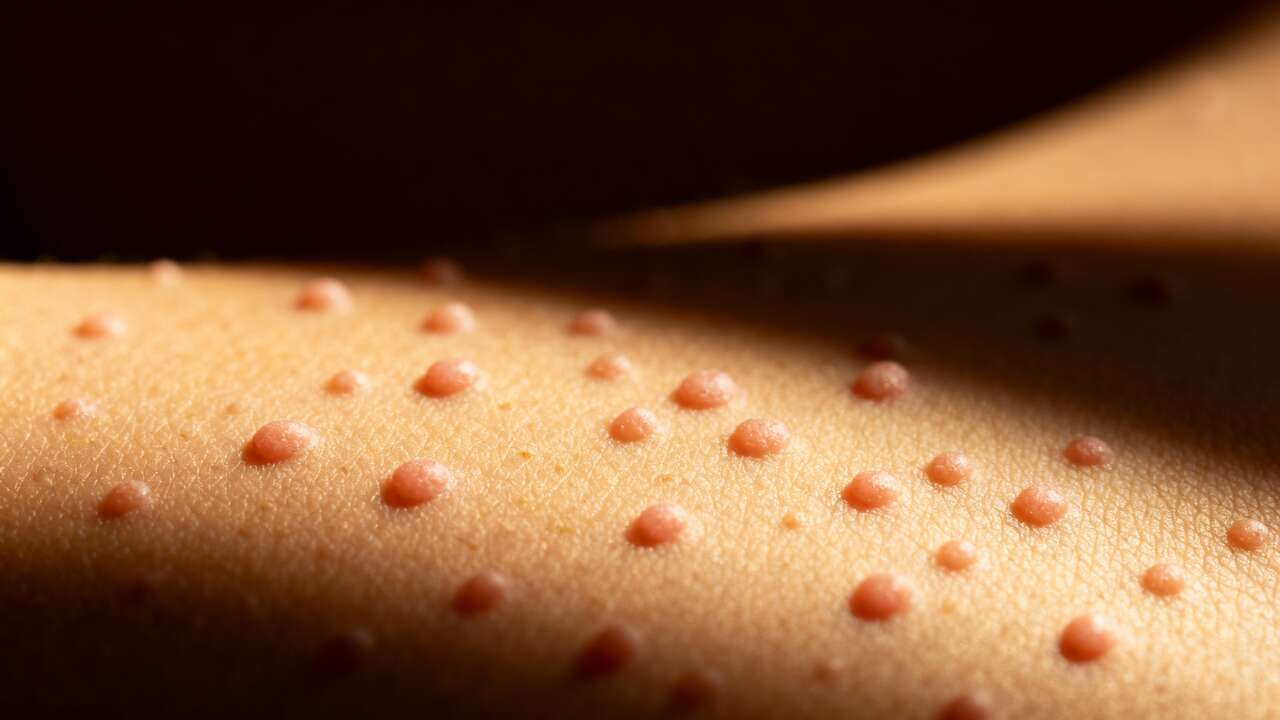 Grani di miglio: cosa sono, perché compaiono e come trattarli senza rischi